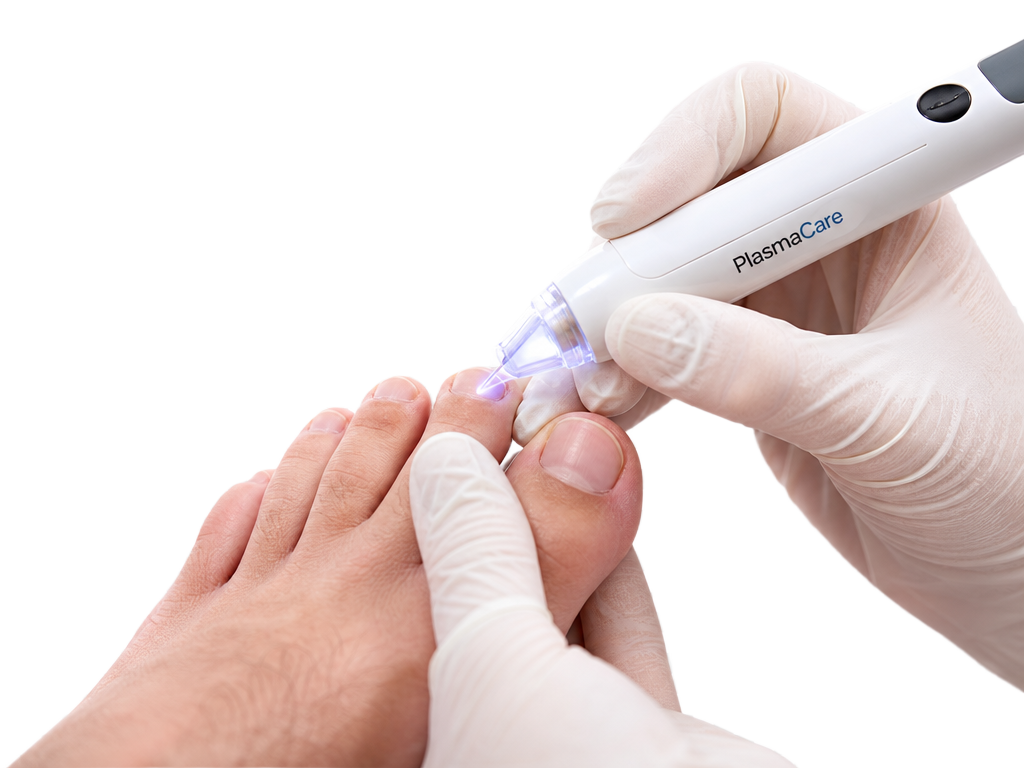 PlasmaCare® Kaltplasma-Gerät bei der Anwendung an einem Fußnagel in der podologischen Praxis